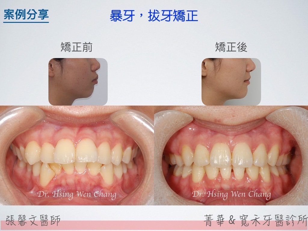 暴牙,拔牙矯正,黑三角
