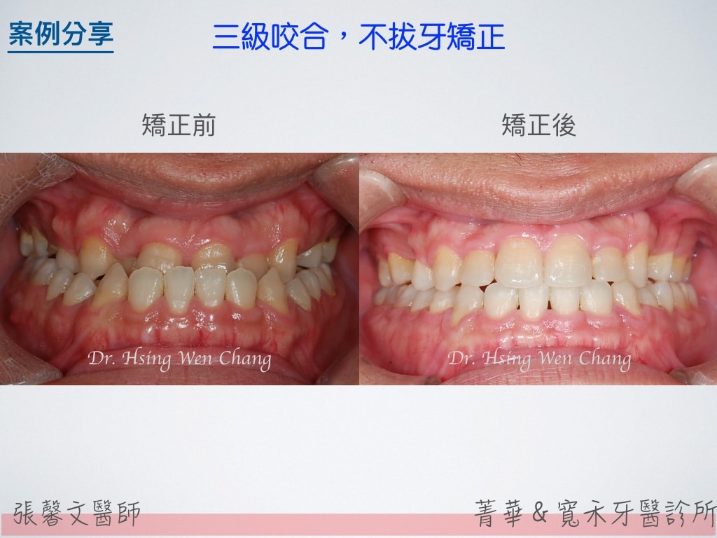 三級咬合，不拔牙矯正