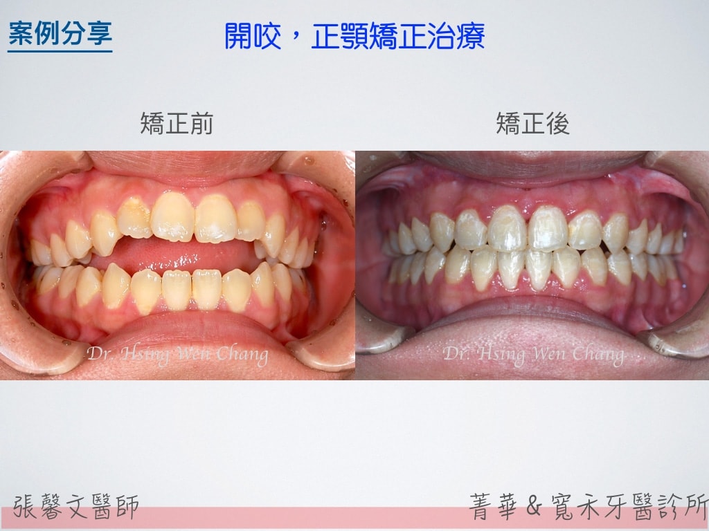 開咬，正顎矯正治療