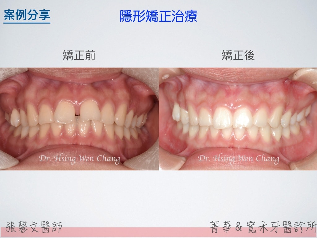 隱形矯正治療