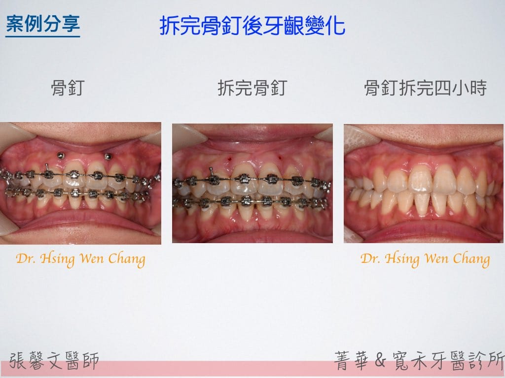 骨釘的使用 寬禾口腔顎面外科牙醫診所