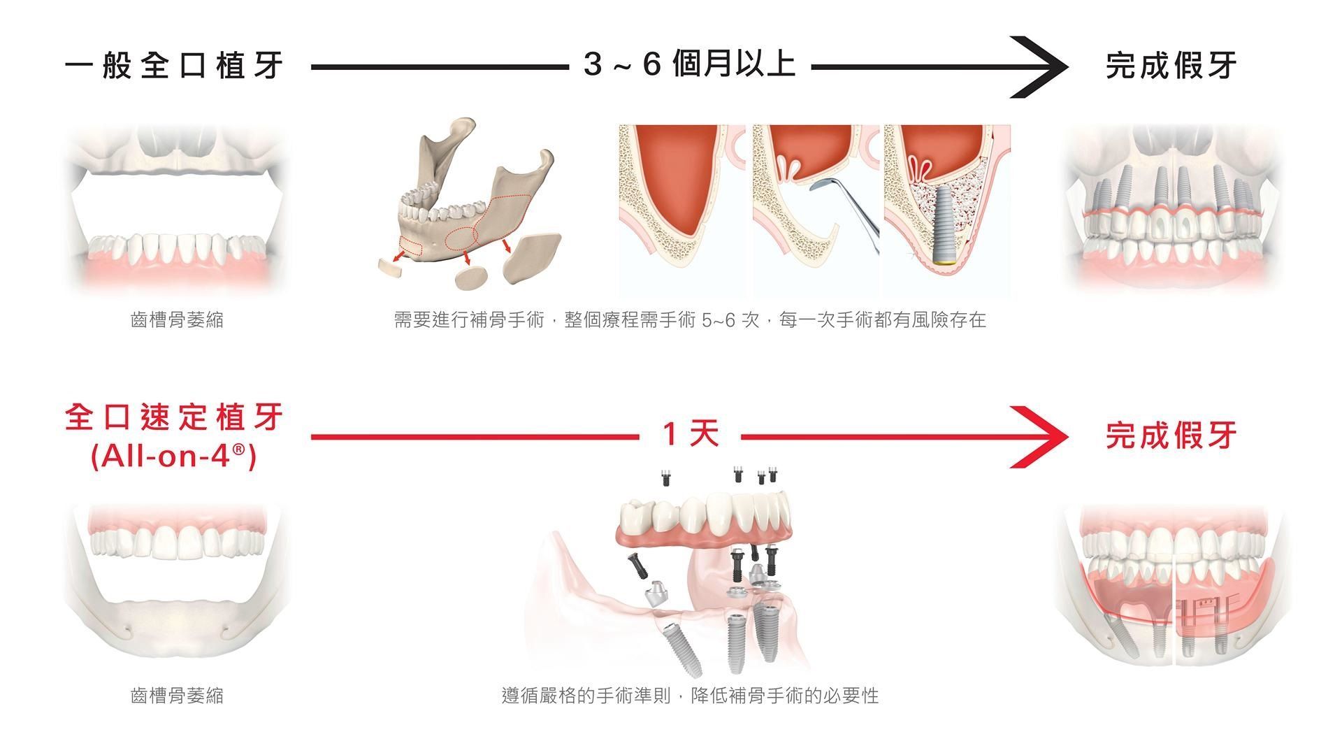 台中all on 4 全口重建植牙手術